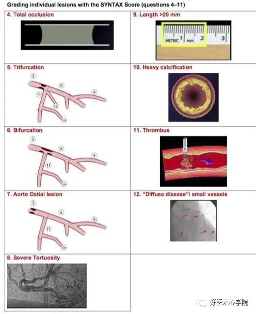 造影导丝是什么珍藏 冠脉造影从流程到诊断，基础必备！_https://www.jmylbn.com_新闻资讯_第100张