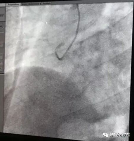 造影导丝是什么珍藏 冠脉造影从流程到诊断，基础必备！_https://www.jmylbn.com_新闻资讯_第35张