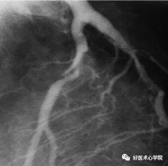 造影导丝是什么珍藏 冠脉造影从流程到诊断，基础必备！_https://www.jmylbn.com_新闻资讯_第94张