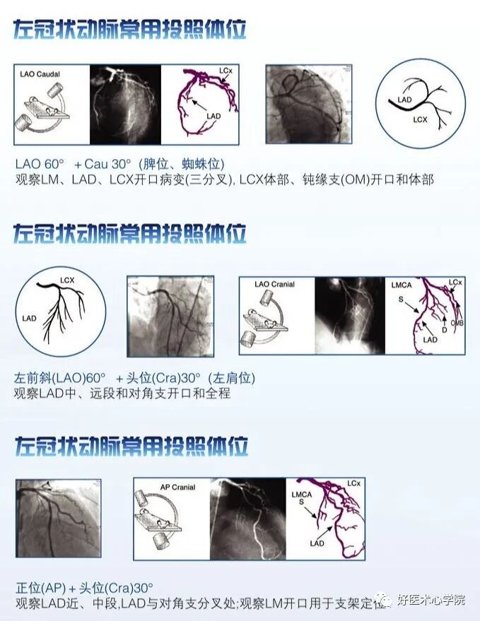 造影导丝是什么珍藏 冠脉造影从流程到诊断，基础必备！_https://www.jmylbn.com_新闻资讯_第73张