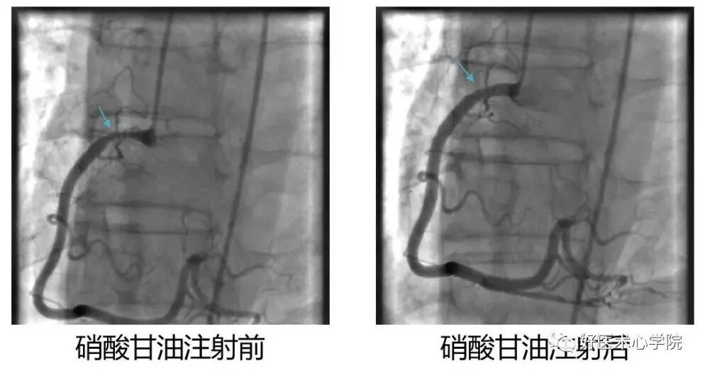 造影导丝是什么珍藏 冠脉造影从流程到诊断，基础必备！_https://www.jmylbn.com_新闻资讯_第87张