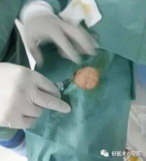 造影导丝是什么珍藏 冠脉造影从流程到诊断，基础必备！_https://www.jmylbn.com_新闻资讯_第20张