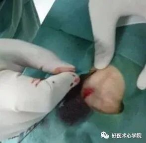 造影导丝是什么珍藏 冠脉造影从流程到诊断，基础必备！_https://www.jmylbn.com_新闻资讯_第27张