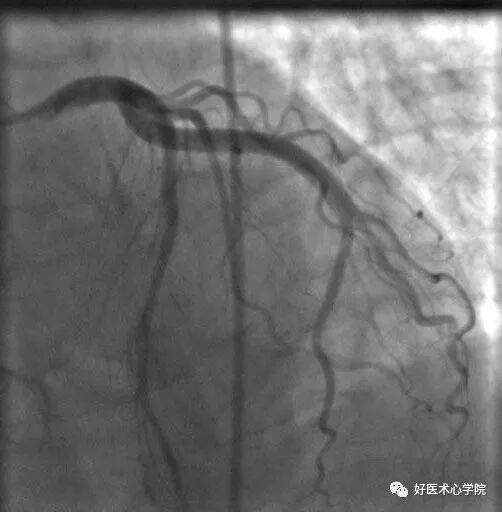 造影导丝是什么珍藏 冠脉造影从流程到诊断，基础必备！_https://www.jmylbn.com_新闻资讯_第90张