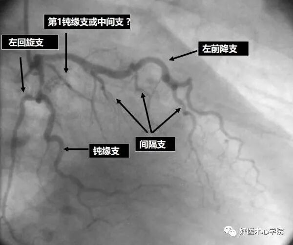 造影导丝是什么珍藏 冠脉造影从流程到诊断，基础必备！_https://www.jmylbn.com_新闻资讯_第70张