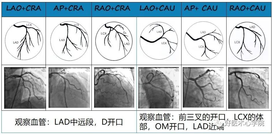 造影导丝是什么珍藏 冠脉造影从流程到诊断，基础必备！_https://www.jmylbn.com_新闻资讯_第76张