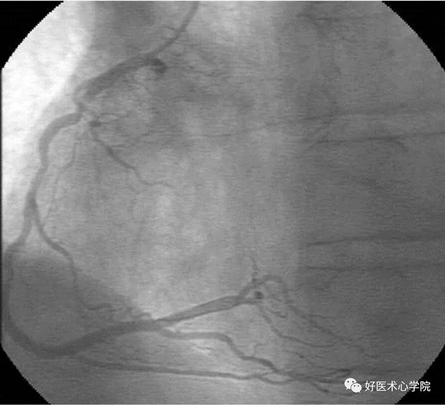 造影导丝是什么珍藏 冠脉造影从流程到诊断，基础必备！_https://www.jmylbn.com_新闻资讯_第57张
