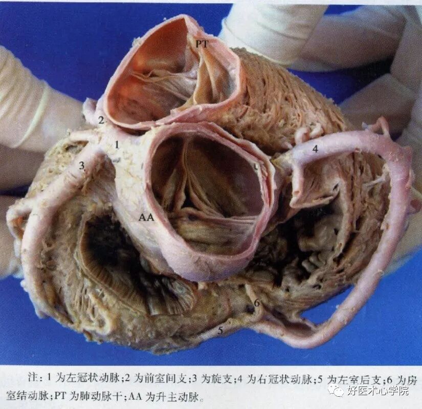 造影导丝是什么珍藏 冠脉造影从流程到诊断，基础必备！_https://www.jmylbn.com_新闻资讯_第5张