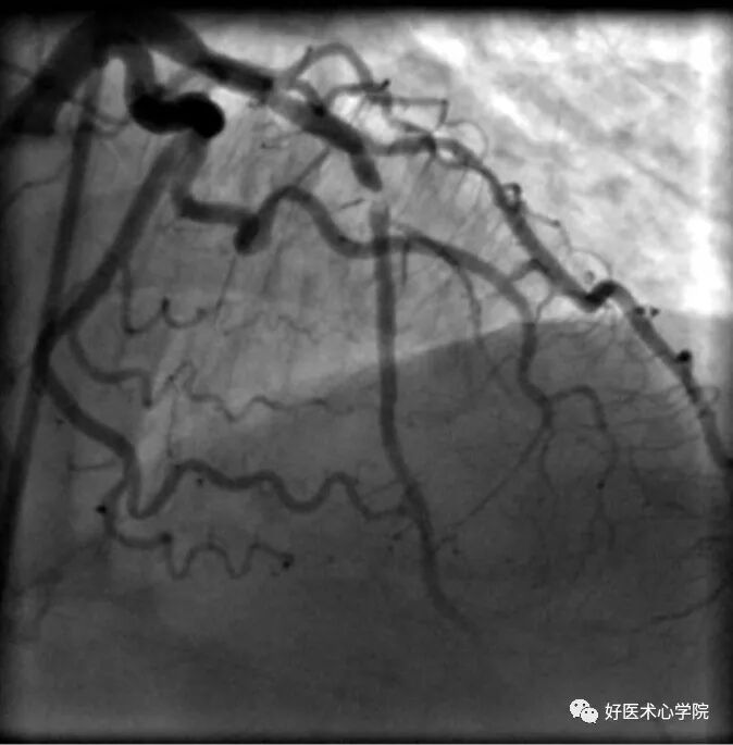 造影导丝是什么珍藏 冠脉造影从流程到诊断，基础必备！_https://www.jmylbn.com_新闻资讯_第84张
