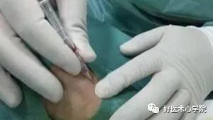 造影导丝是什么珍藏 冠脉造影从流程到诊断，基础必备！_https://www.jmylbn.com_新闻资讯_第22张