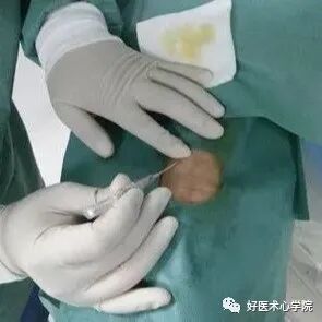 造影导丝是什么珍藏 冠脉造影从流程到诊断，基础必备！_https://www.jmylbn.com_新闻资讯_第21张