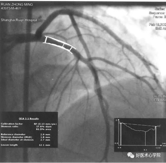 造影导丝是什么珍藏 冠脉造影从流程到诊断，基础必备！_https://www.jmylbn.com_新闻资讯_第82张