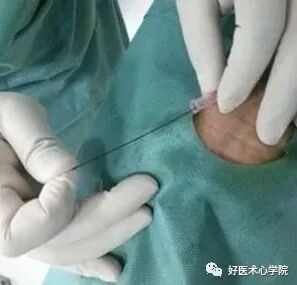 造影导丝是什么珍藏 冠脉造影从流程到诊断，基础必备！_https://www.jmylbn.com_新闻资讯_第25张