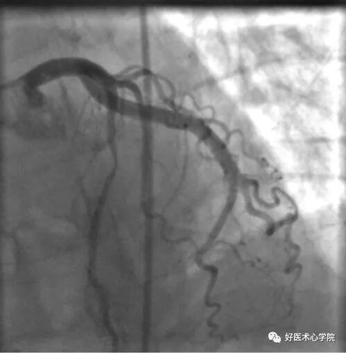 造影导丝是什么珍藏 冠脉造影从流程到诊断，基础必备！_https://www.jmylbn.com_新闻资讯_第89张