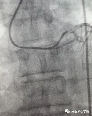 造影导丝是什么珍藏 冠脉造影从流程到诊断，基础必备！_https://www.jmylbn.com_新闻资讯_第33张