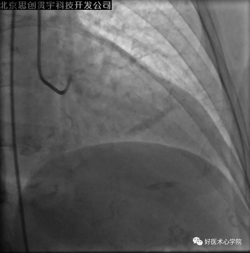 造影导丝是什么珍藏 冠脉造影从流程到诊断，基础必备！_https://www.jmylbn.com_新闻资讯_第86张