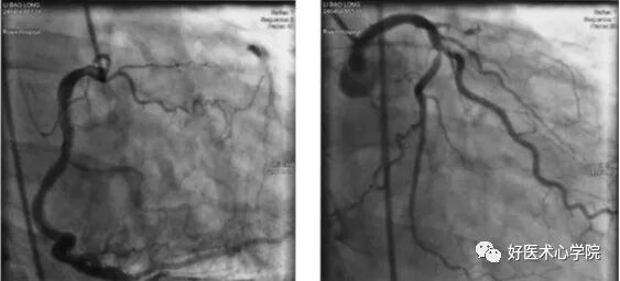 造影导丝是什么珍藏 冠脉造影从流程到诊断，基础必备！_https://www.jmylbn.com_新闻资讯_第96张