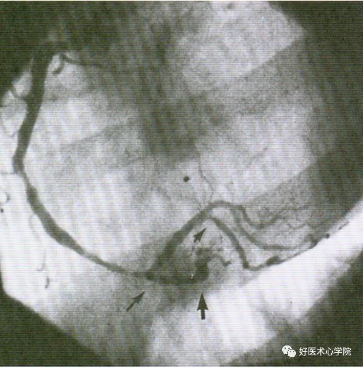造影导丝是什么珍藏 冠脉造影从流程到诊断，基础必备！_https://www.jmylbn.com_新闻资讯_第56张