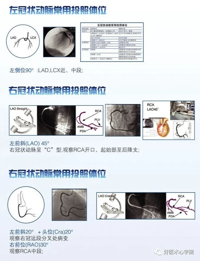造影导丝是什么珍藏 冠脉造影从流程到诊断，基础必备！_https://www.jmylbn.com_新闻资讯_第75张