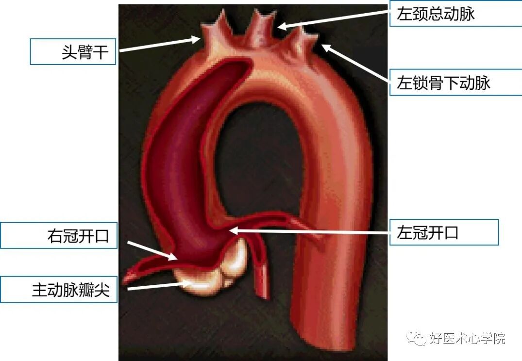 造影导丝是什么珍藏 冠脉造影从流程到诊断，基础必备！_https://www.jmylbn.com_新闻资讯_第4张