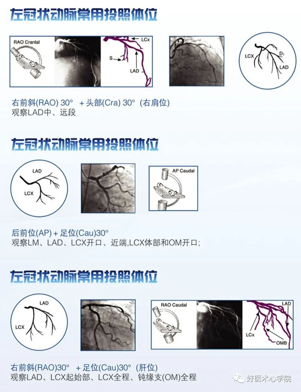 造影导丝是什么珍藏 冠脉造影从流程到诊断，基础必备！_https://www.jmylbn.com_新闻资讯_第74张