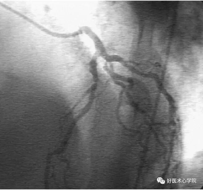 造影导丝是什么珍藏 冠脉造影从流程到诊断，基础必备！_https://www.jmylbn.com_新闻资讯_第58张
