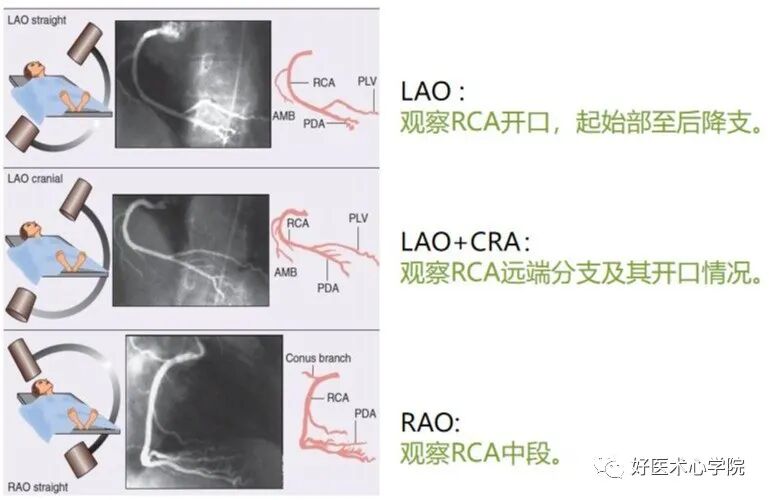 造影导丝是什么珍藏 冠脉造影从流程到诊断，基础必备！_https://www.jmylbn.com_新闻资讯_第77张