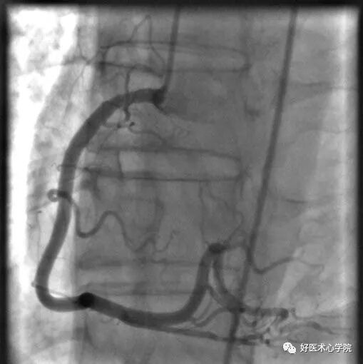 造影导丝是什么珍藏 冠脉造影从流程到诊断，基础必备！_https://www.jmylbn.com_新闻资讯_第88张