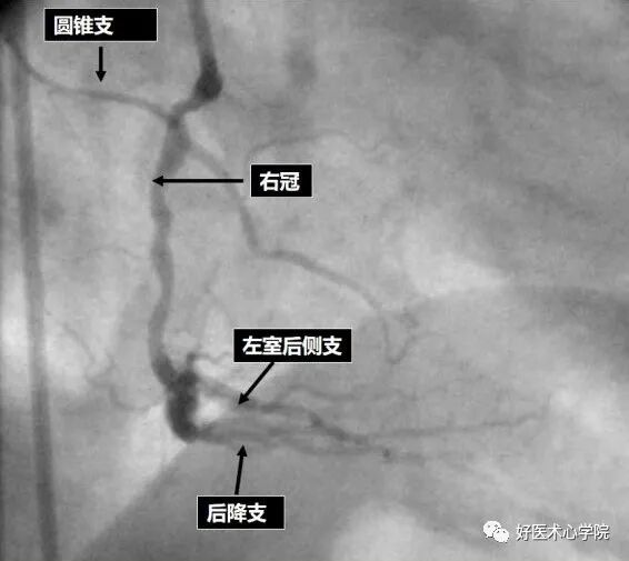 造影导丝是什么珍藏 冠脉造影从流程到诊断，基础必备！_https://www.jmylbn.com_新闻资讯_第68张