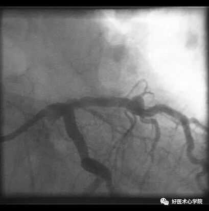 造影导丝是什么珍藏 冠脉造影从流程到诊断，基础必备！_https://www.jmylbn.com_新闻资讯_第81张