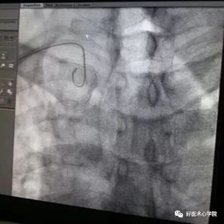 造影导丝是什么珍藏 冠脉造影从流程到诊断，基础必备！_https://www.jmylbn.com_新闻资讯_第30张