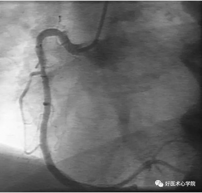 造影导丝是什么珍藏 冠脉造影从流程到诊断，基础必备！_https://www.jmylbn.com_新闻资讯_第62张