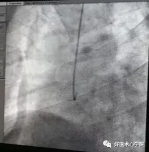 造影导丝是什么珍藏 冠脉造影从流程到诊断，基础必备！_https://www.jmylbn.com_新闻资讯_第34张
