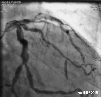 造影导丝是什么珍藏 冠脉造影从流程到诊断，基础必备！_https://www.jmylbn.com_新闻资讯_第91张