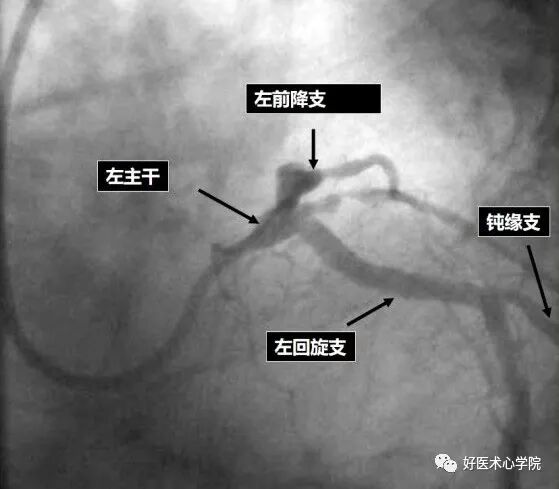 造影导丝是什么珍藏 冠脉造影从流程到诊断，基础必备！_https://www.jmylbn.com_新闻资讯_第66张