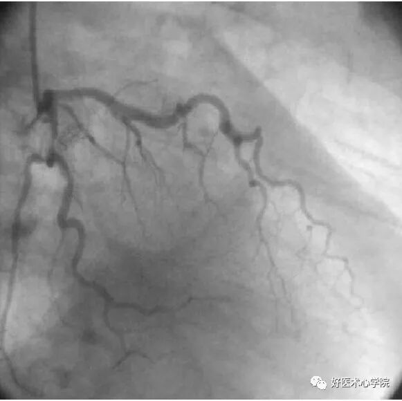 造影导丝是什么珍藏 冠脉造影从流程到诊断，基础必备！_https://www.jmylbn.com_新闻资讯_第59张