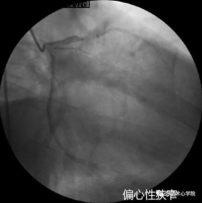 造影导丝是什么珍藏 冠脉造影从流程到诊断，基础必备！_https://www.jmylbn.com_新闻资讯_第80张