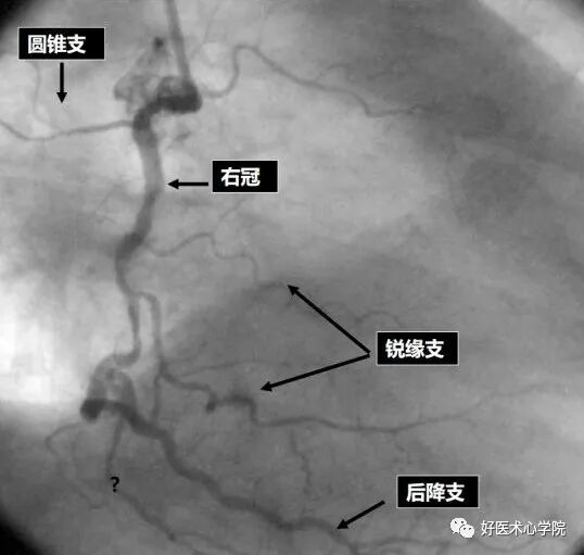 造影导丝是什么珍藏 冠脉造影从流程到诊断，基础必备！_https://www.jmylbn.com_新闻资讯_第69张