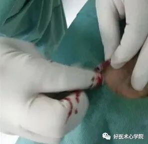 造影导丝是什么珍藏 冠脉造影从流程到诊断，基础必备！_https://www.jmylbn.com_新闻资讯_第26张