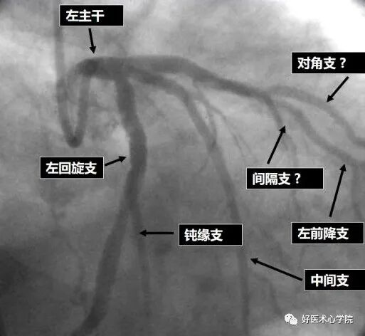 造影导丝是什么珍藏 冠脉造影从流程到诊断，基础必备！_https://www.jmylbn.com_新闻资讯_第64张