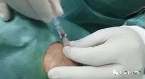 造影导丝是什么珍藏 冠脉造影从流程到诊断，基础必备！_https://www.jmylbn.com_新闻资讯_第23张