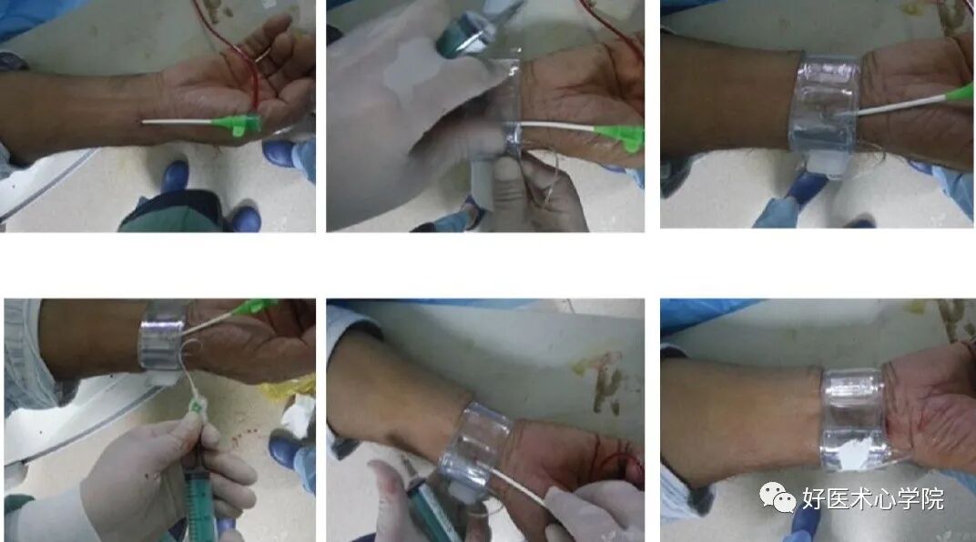 造影导丝是什么珍藏 冠脉造影从流程到诊断，基础必备！_https://www.jmylbn.com_新闻资讯_第36张