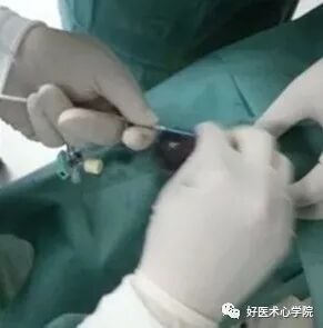 造影导丝是什么珍藏 冠脉造影从流程到诊断，基础必备！_https://www.jmylbn.com_新闻资讯_第28张