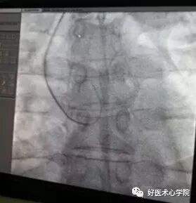 造影导丝是什么珍藏 冠脉造影从流程到诊断，基础必备！_https://www.jmylbn.com_新闻资讯_第31张