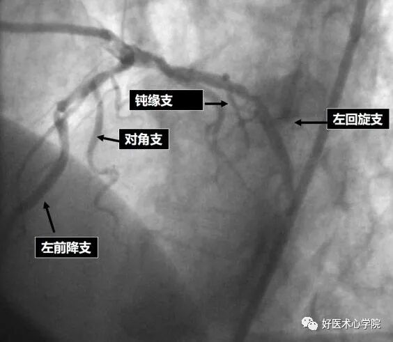 造影导丝是什么珍藏 冠脉造影从流程到诊断，基础必备！_https://www.jmylbn.com_新闻资讯_第65张