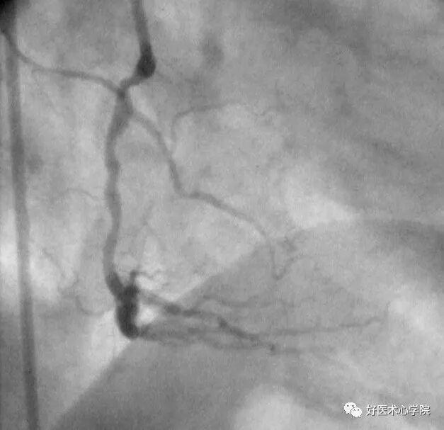造影导丝是什么珍藏 冠脉造影从流程到诊断，基础必备！_https://www.jmylbn.com_新闻资讯_第61张
