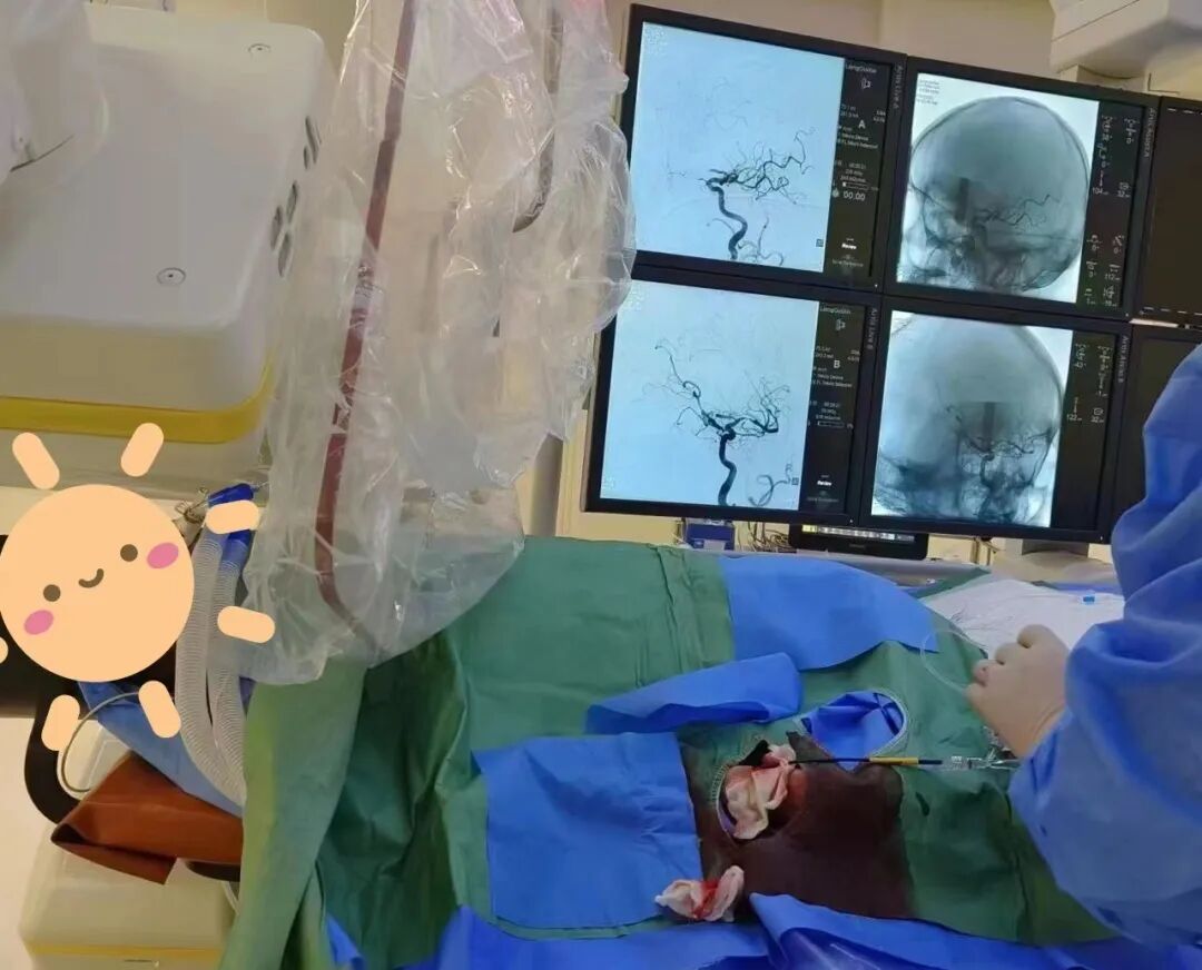 什么叫桡鞘逢山开路，遇水搭桥 ｜ 我院完成全省首例应用长鞘经桡动脉入路左侧大脑中动脉血管成形术_https://www.jmylbn.com_新闻资讯_第2张