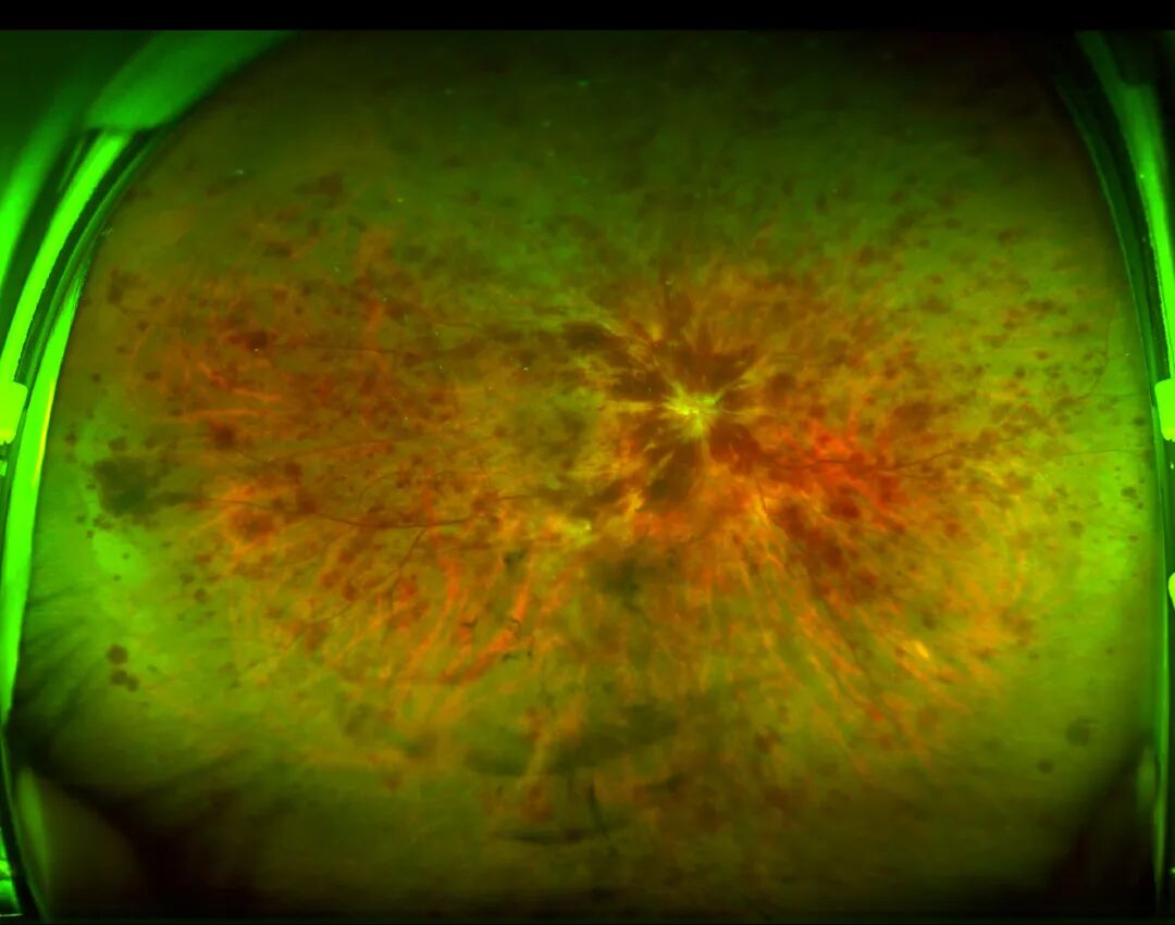 怎么看眼底相机世界睛彩 尽收眼底——你不知道的神奇“眼底照相机”_https://www.jmylbn.com_新闻资讯_第9张