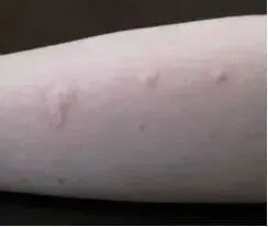 医院儿童病床为什么高对过敏说“再见”——永煤总医院儿科开展过敏原试验及治疗_https://www.jmylbn.com_新闻资讯_第10张