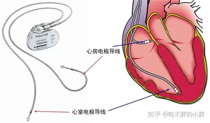 百多力起搏器怎么样迎新春丨我院心脏起搏器程控门诊全面升级_https://www.jmylbn.com_新闻资讯_第8张